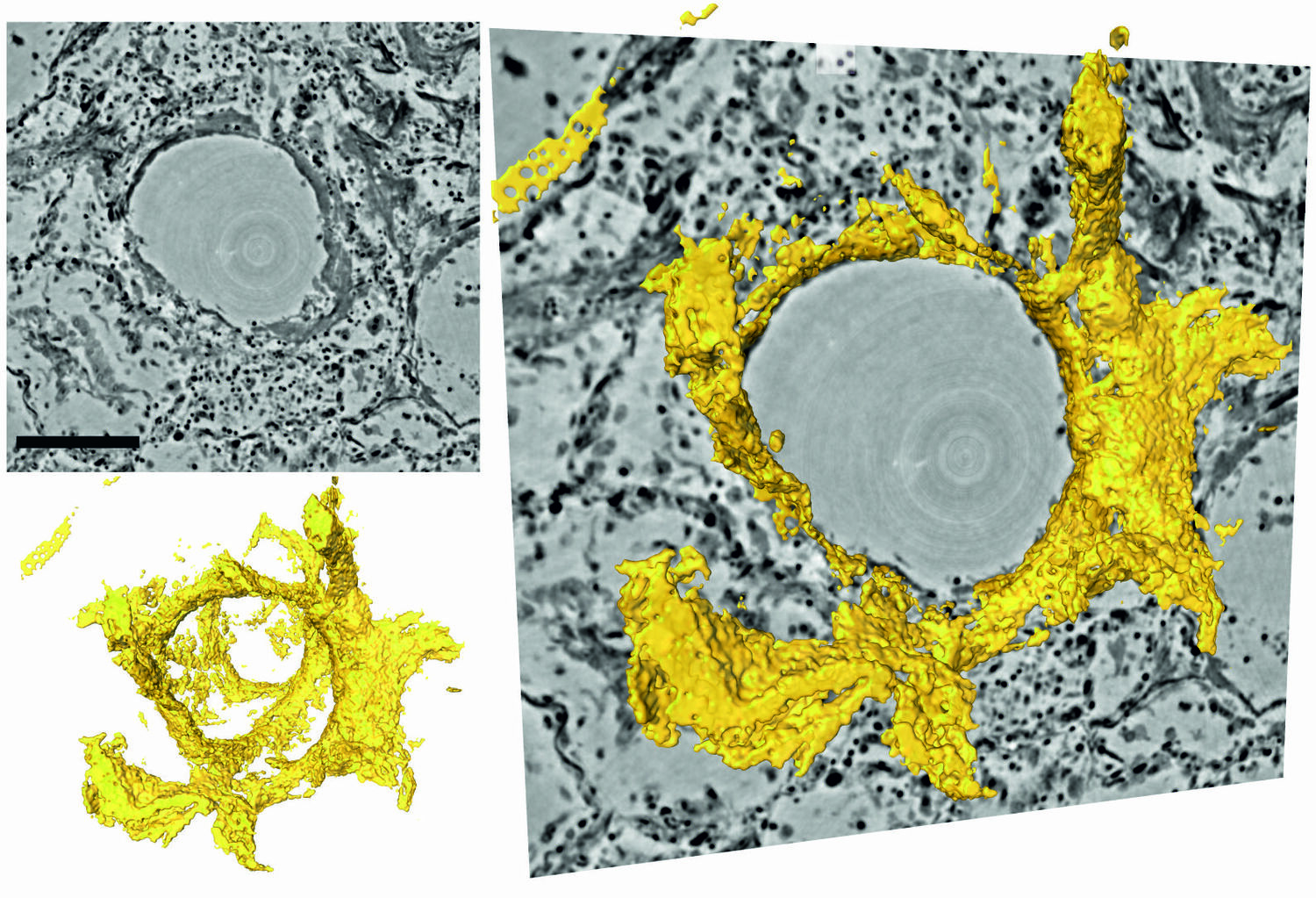 Schnitte durch das dreidimensionale Rekonstruktionsvolumen (links oben, grau) um ein Lungenbläschen mit Hyalinmembran (links unten, gelb), rechts eine Überblendung. Im Zentrum befindet sich das Luftbläschen (Alveole). Die Elektronendichte ist durch unterschiedliche Grautöne dargestellt. An der Innenseite des Luftbläschens schlägt sich eine Schicht aus Proteinen und abgestorbenen Zellenresten nieder, die sogenannte Hyalinmembran. Diese Ablagerung, die durch das neue Verfahren erstmals in ihrer dreidimensionalen Struktur dargestellt werden kann, reduziert den Gasaustausch und führt zu Atemnot.