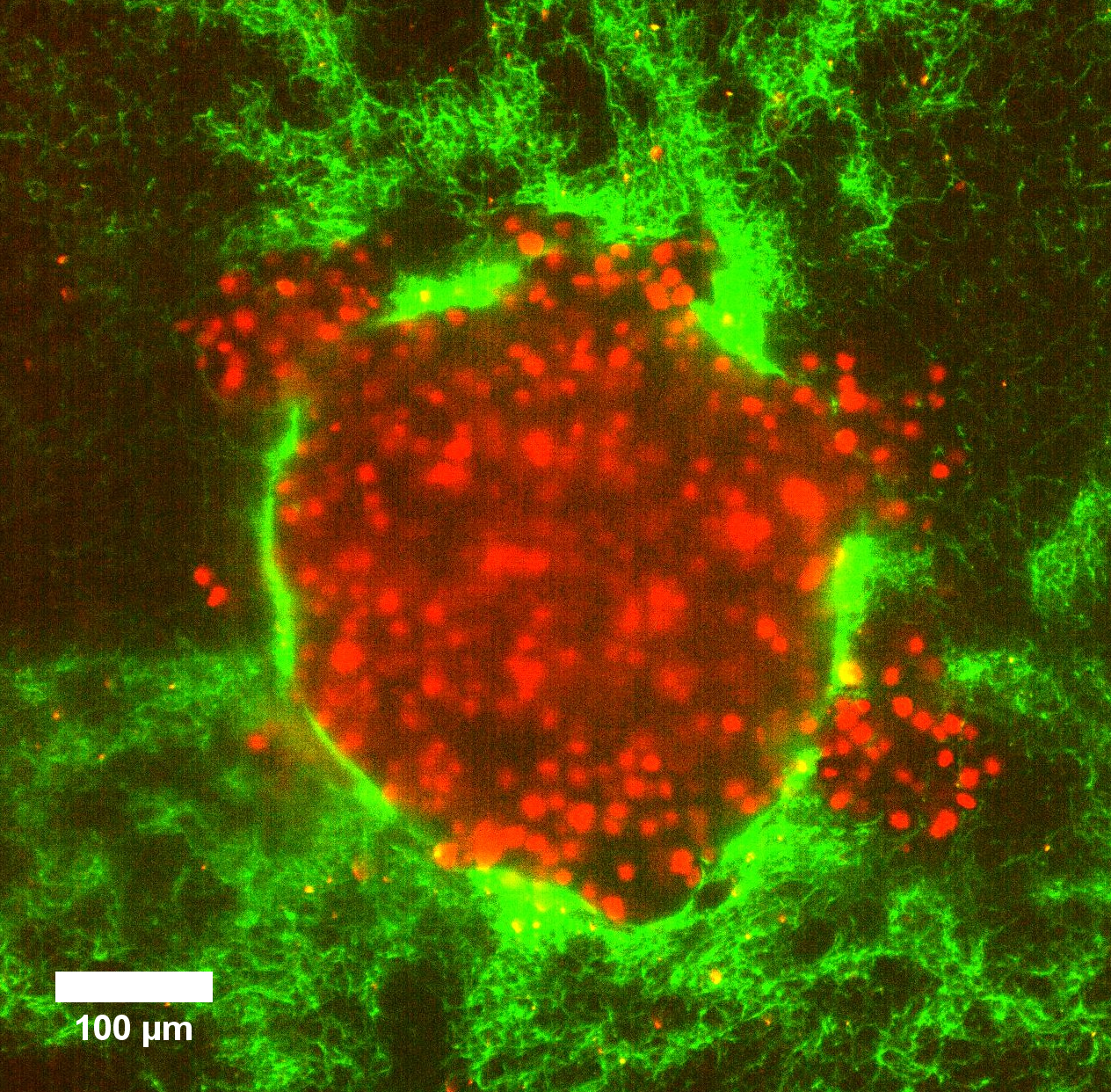 Tumormodell mit Klumpen von Krebszellen (ihre Kerne sind rot markiert) in einer weichen 3-D-Matrix aus Kollagen. Der Druck bewirkt, dass die Krebszellen schnell in die umgebende weiche Matrix platzen.