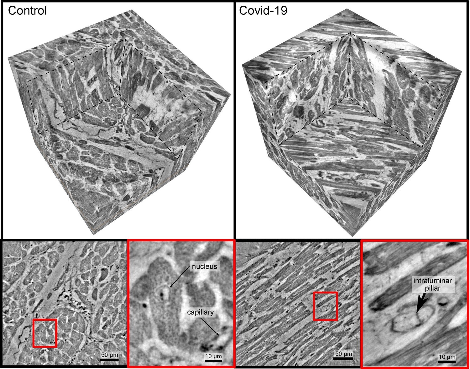 Healthy heart tissue (left) and in severe Covid-19 (right). While the blood vessels in the healthy case show an intact structure (bottom right), one can see cavities or pouches and tiny tubular structures forming in the fine blood vessels (capillaries) in the Covid-19 tissue sample, which indicate particular morphological changes.