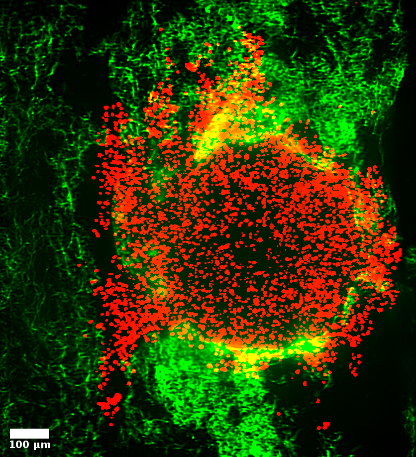 Tumormodell mit Klumpen von Krebszellen (ihre Kerne sind rot markiert) in einer weichen 3-D-Matrix aus Kollagen, das zeigt, wie der Druck die Krebszellen veranlasst, schnell in Taschen in der umgebenden weichen Matrix zu platzen.