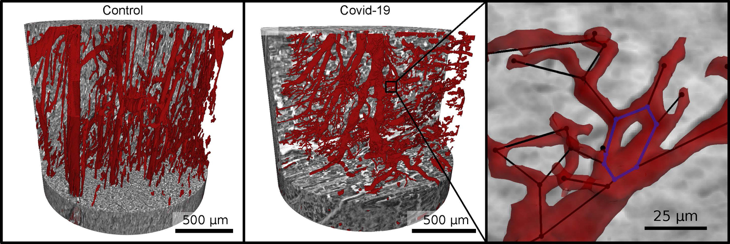 Gefäßnetzwerk (rot) im gesunden Herzgewebe (links) und bei schwerem Verlauf von Covid-19 (rechts). Durch fehlgeleitete Neubildung des Netzwerks in Folge von Covid-19 entstehen zahlreiche Verzweigungen, Verästelungen und sogar Schlaufen in den Kapillaren, die sich mathematisch durch Grafen analysieren lassen.
